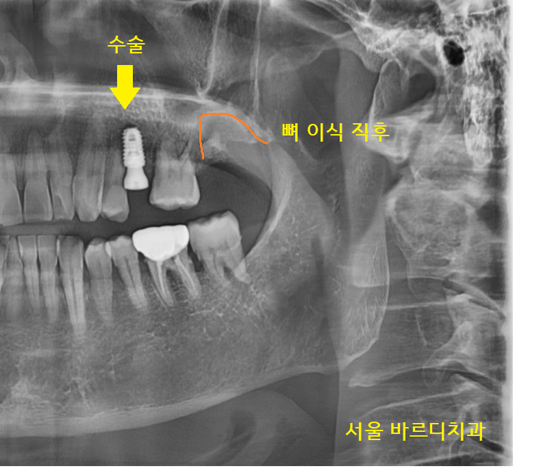 덕풍동 치과 임플란트 불가 판정받으신 환자분 살렸습니다. 관련 이미지 5