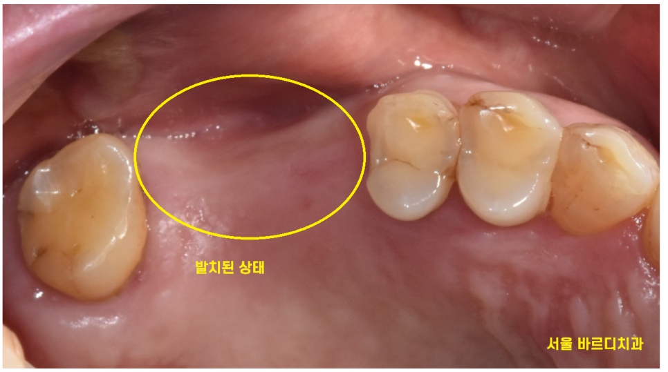 강일동 치과 전남 완도에서 올라오셔서 발치 후 당일 임플란트 완료하였습니다. 관련 이미지 3