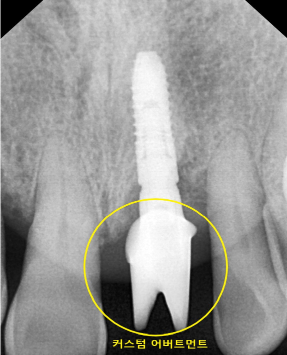 상일동치과 서울바르디치과 무절개 네비게이션 임플란트 치료증례 #3 관련 이미지 8