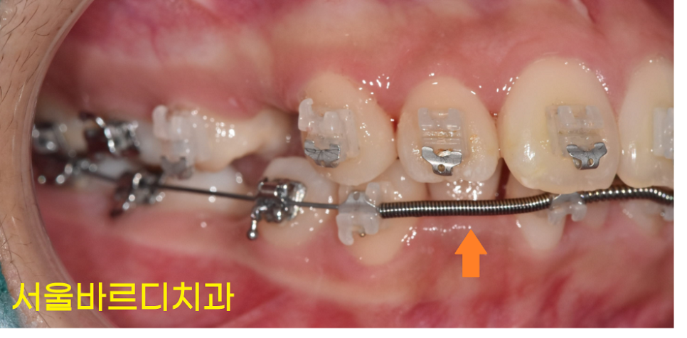 치아 교정 스프링 공간을 확보하기 위한 오픈코일 알아봐요 관련 이미지 2