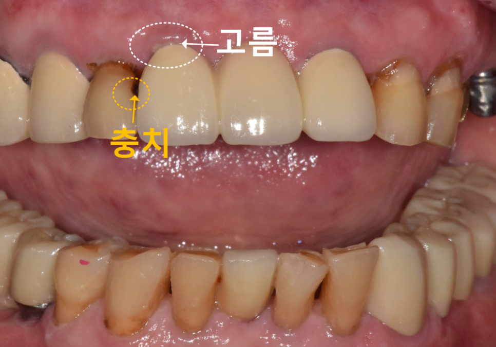 상일동 임플란트 심한 충치로 인한 치아 부러짐 해결한 사례 관련 이미지 3