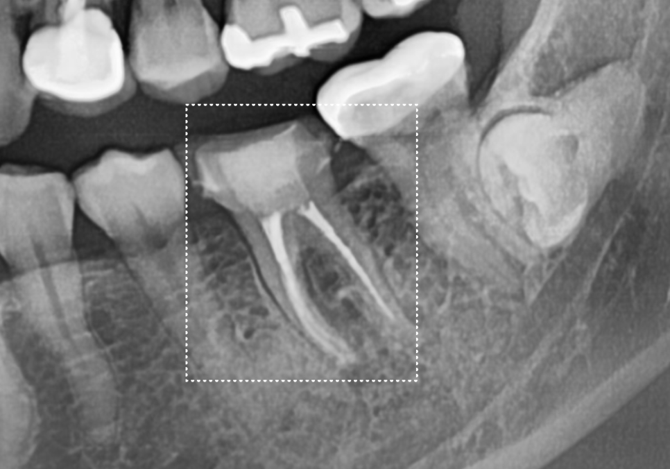 Honestly, Can an Unbroken Temporary Tooth Be Used Without a Crown? image 10
