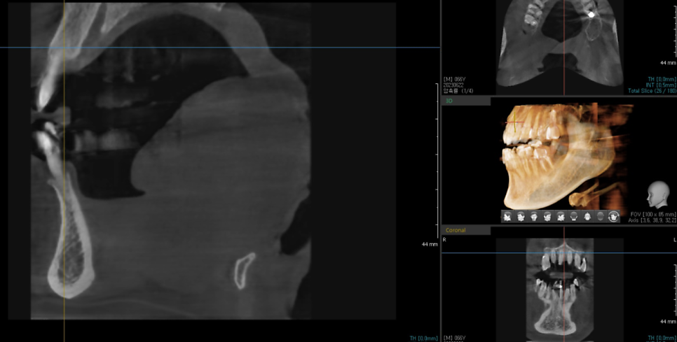 강동구 임플란트 위 아래 어금니 동시 식립으로 치료기간 대폭 축소 관련 이미지 5