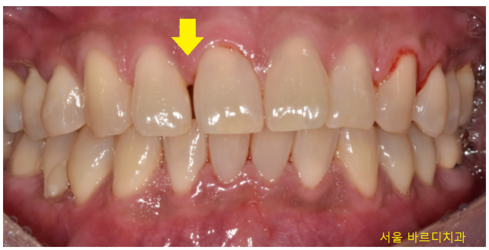 고덕 그라시움 치과 벌어진 앞니 메꾸기 당일 레진으로 치료했습니다. 관련 이미지 4