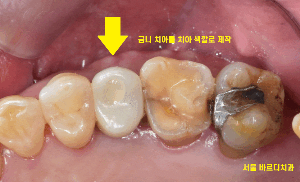 미사 임플란트 금니 빠짐 보철물 빠졌을 때 대처법 알려드려요 관련 이미지 1