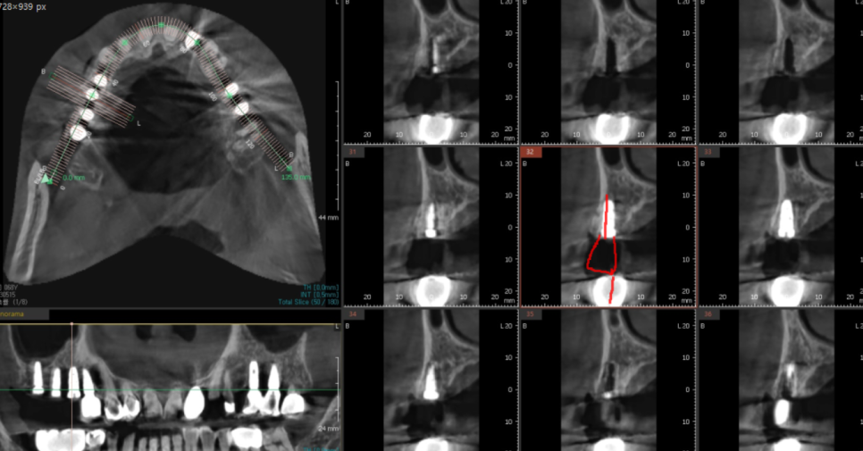 고덕동 치과치료 씌운 치아 문제가 생겼어요 관련 이미지 6
