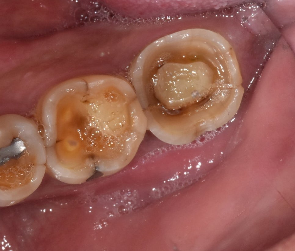 Implant Treatment for a Fractured Molar Split in Half After Neglect Following Root Canal Treatment image 1