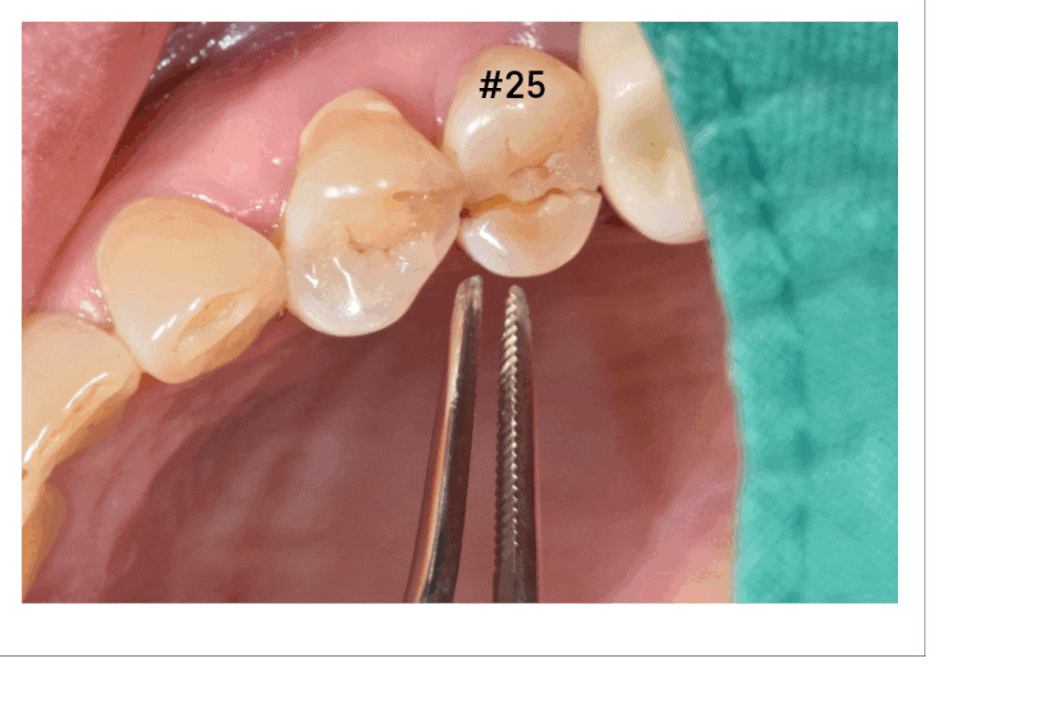 치아 쪼개짐으로 상악동 거상술 동반한 임플란트 수술 관련 이미지 3