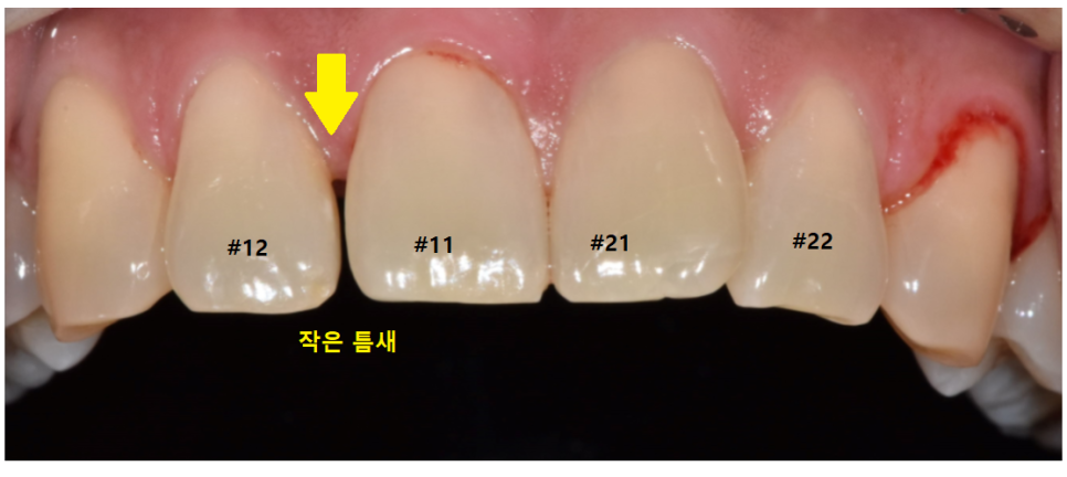 고덕 그라시움 치과 벌어진 앞니 메꾸기 당일 레진으로 치료했습니다. 관련 이미지 2