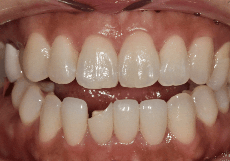 앞니 라미네이트 교체, 재시술 전 꼭 알아야 할 실패를 줄이는 방법 관련 이미지 9