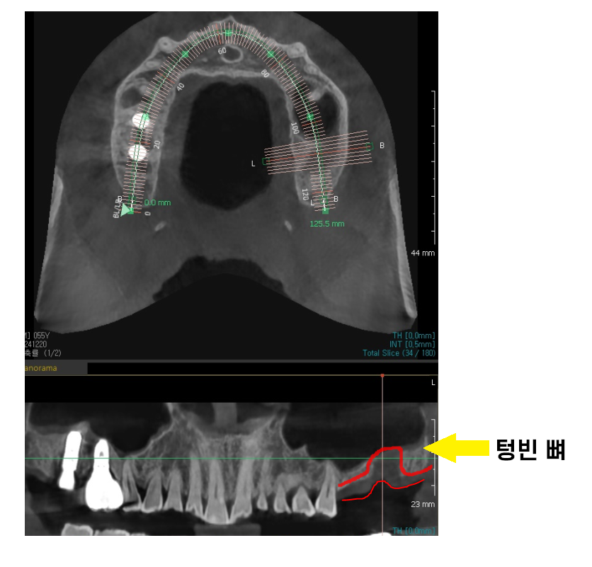 미사역 임플란트 치료 나이 상관이 있을까? 관련 이미지 3