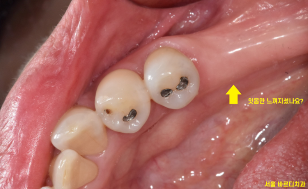 길동 치과 임플란트 2차 수술이요? 예전에 했잖아요 관련 이미지 3