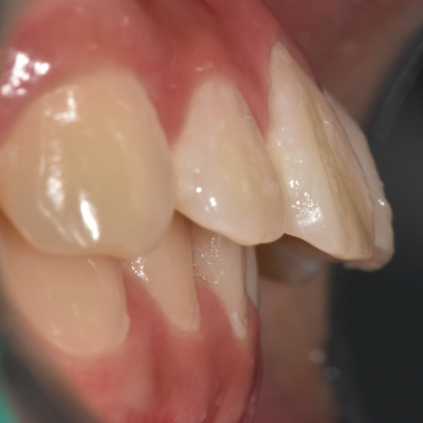 Can Protruding Mouth Be Corrected with Orthodontics Alone, Without Surgery? Sangil-dong Orthodontic Clinic image 6
