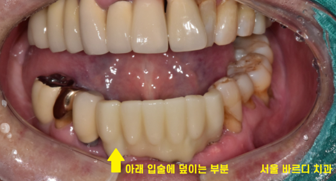 강동구 치과 앞니 흔들림 임플란트 케이스 관련 이미지 9