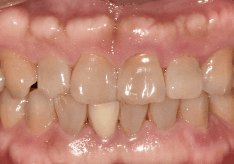 앞니 깨짐 치료 비용, 더이상 치과에 돈 낭비하기 싫다면? 깨지는 원인부터 알아야 합니다. 관련 이미지 15