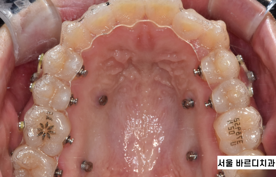 투명교정 치료 과정 이렇게 진행됩니다! 집에서 장치를 받아요! 관련 이미지 4