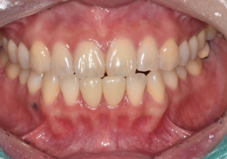 고덕동 무삭제 라미네이트, 실패 없이 하려면 꼭 확인할 3가지 관련 이미지 5