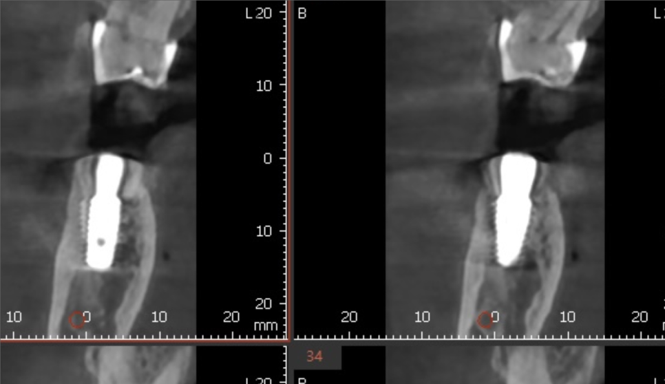 바르디 임플란트는 바르게 심지만, 빠르게 씹습니다. 그간의 경험을 바탕으로요. 관련 이미지 13