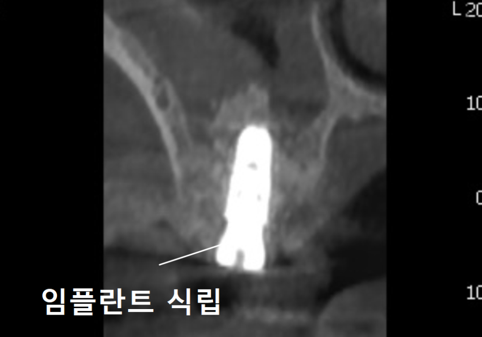 Sinusitis Caused by Teeth: Why Do You Tell Me to Go to the Dentist When My Nose Hurts? image 13