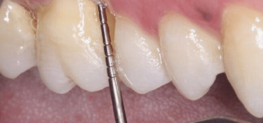 덕풍동 치과 잇몸 욱신 욱신 원인 찾아 임플란트 수술하였습니다. 관련 이미지 3