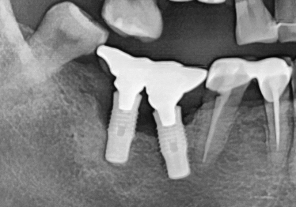 오래된 임플란트, 흔들림과 통증, 어떻게 하면 더 건강하게 쓸 수 있을까? 관련 이미지 5