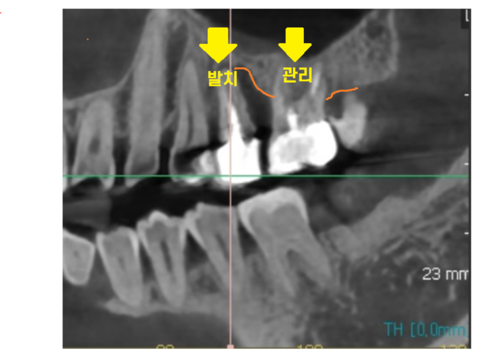 상일동역 치과 추천 임플란트 과정에서 제일 중요한 이것! 관련 이미지 6