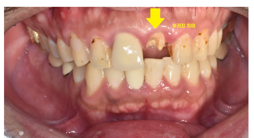 보철치료 하루만에 편하고 빠르게 시간이 없을 때는? 관련 이미지 5