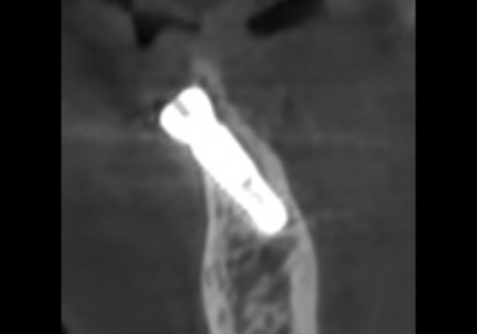 흔들리는 치아 묶어두는 잠간고정술, 오히려 잇몸뼈를 녹일 수도 있다고요? 관련 이미지 10