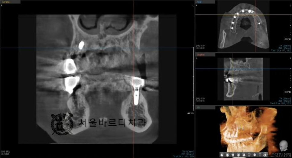 상일동역치과 서울바르디치과 무절개 네비게이션 임플란트 치료증례 #5 관련 이미지 10