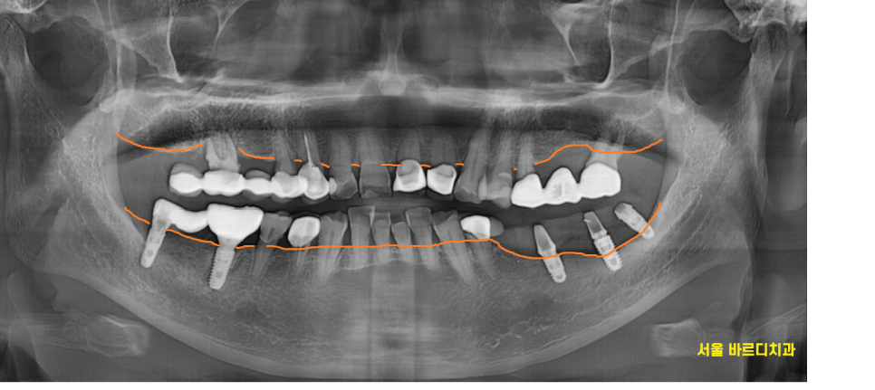 고덕동치과 이가 다 부서졌을 때 임플란트 치료했습니다. 관련 이미지 2