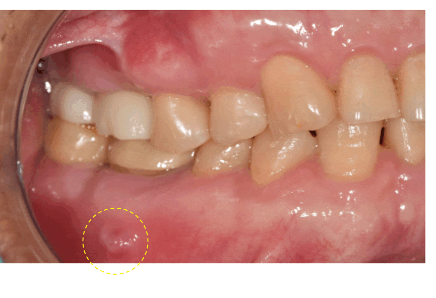 Implant treatment is needed when a gum pimple or pus appears. image 1
