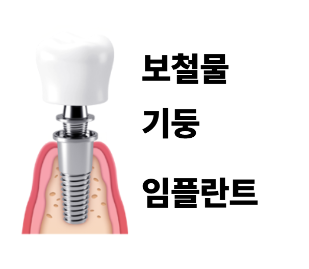 고덕동 치과 임플란트도 교체 주기가 있을까? 기준은? 관련 이미지 2