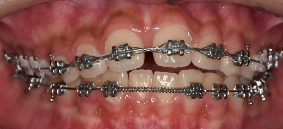 Separately or All at Once for Braces? Click Here if You’re Curious image 7