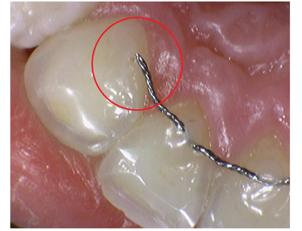 Two Types of Retainers Are Needed After Orthodontic Treatment: Bonded and Removable image 4