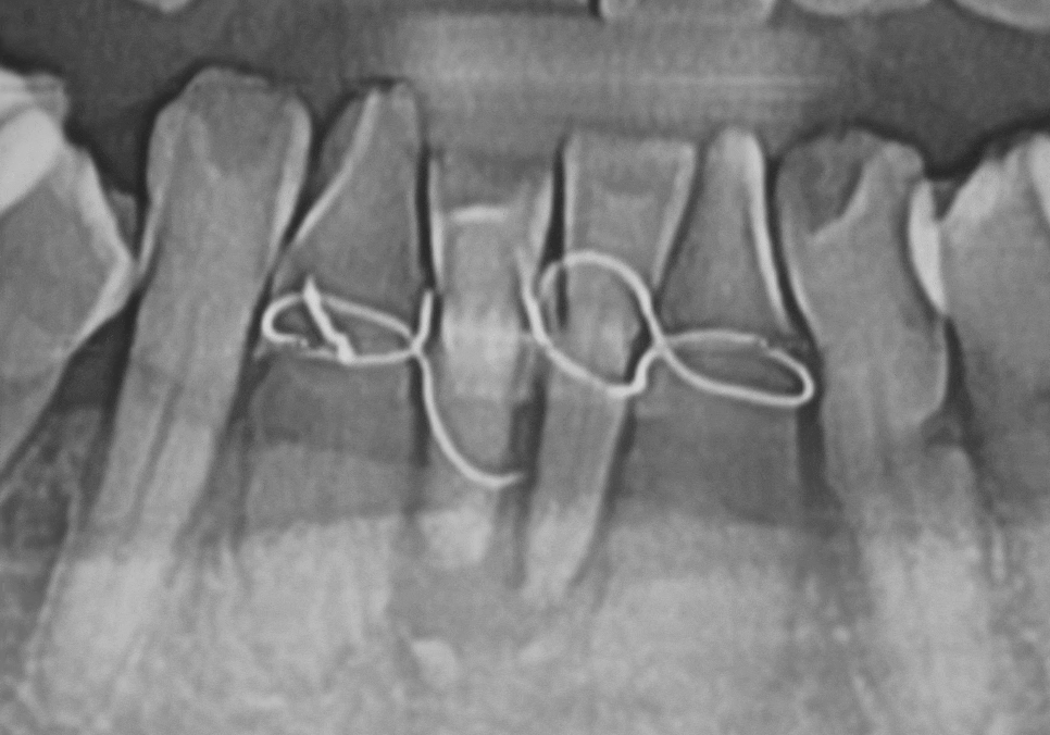 흔들리는 치아 묶어두는 잠간고정술, 오히려 잇몸뼈를 녹일 수도 있다고요? 관련 이미지 14