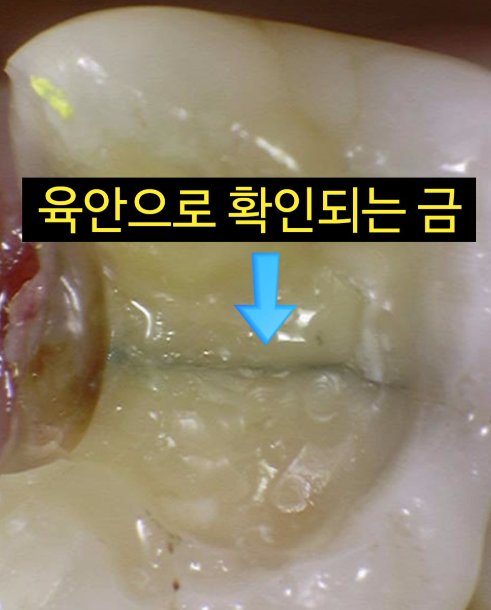 씹을때 찌릿 치아균열증후군 보이지 않아 위험합니다. 관련 이미지 6