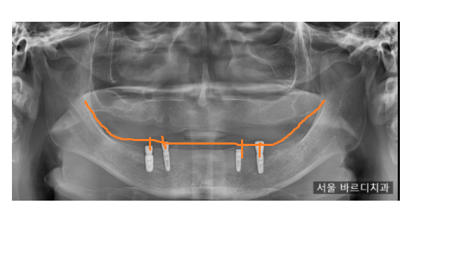 임플란트 틀니 치아가 없을 때 하남미사치과에서 해결하세요. 관련 이미지 7