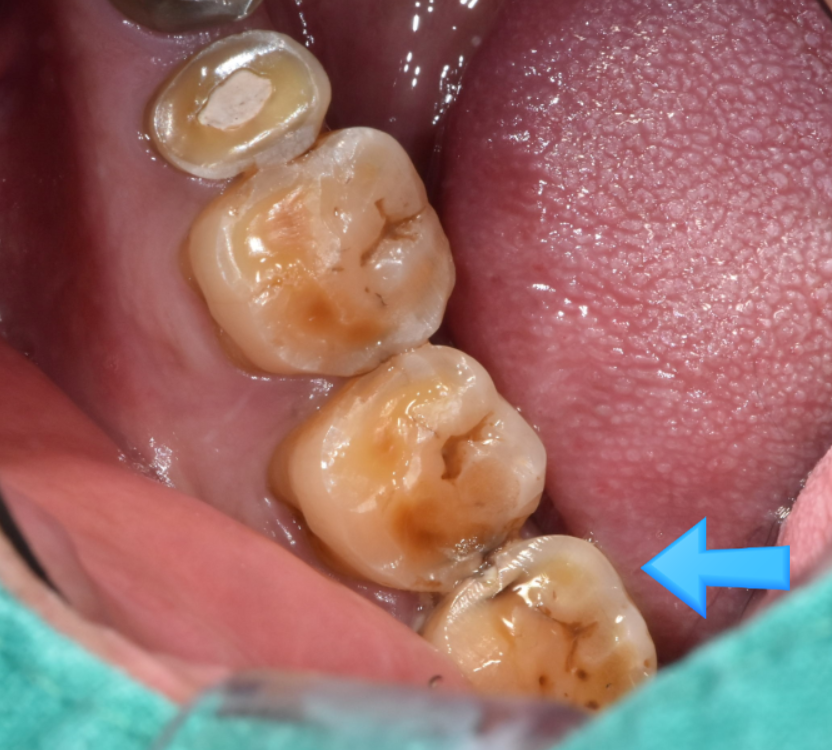 하남 미사 치과 치아 방치하다 올라옴 케이스 보여드립니다. 관련 이미지 4