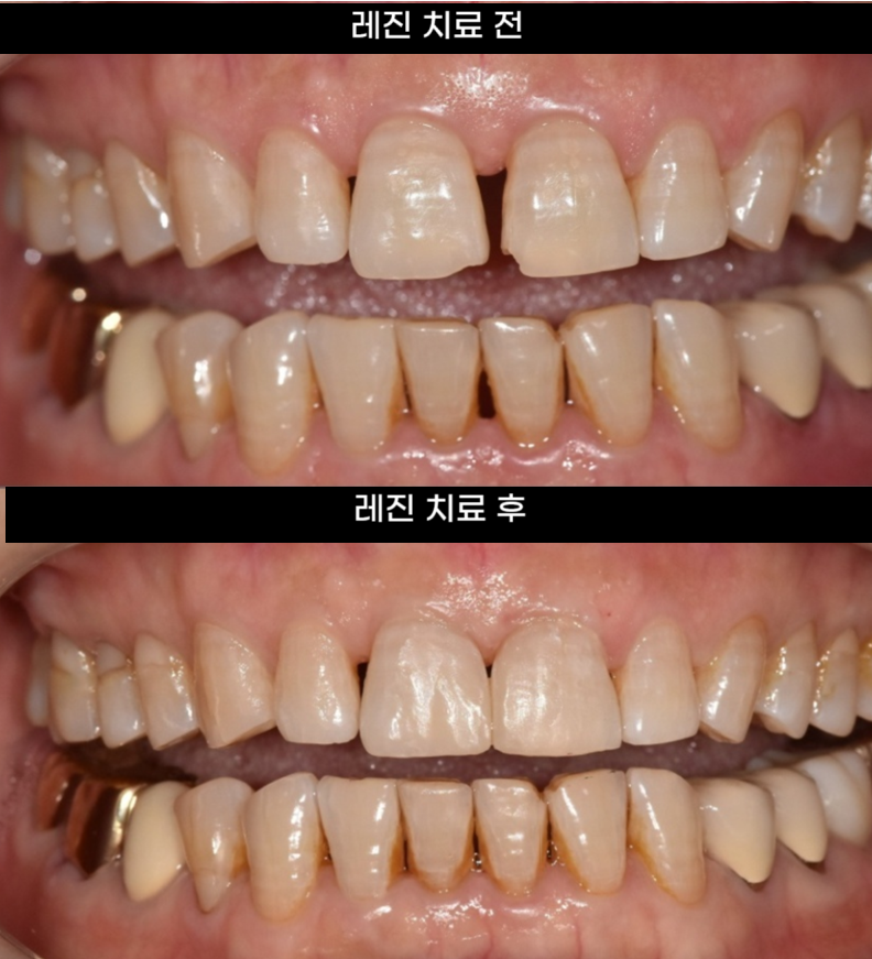 깨지고 벌어진 앞니 사이 레진으로 공간 재분배하였습니다. 관련 이미지 7
