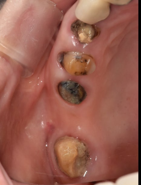 A Case of a 69-Year-Old Who Underwent Immediate Implant Placement After Extraction Due to Tooth Decay in Godeok-dong image 7
