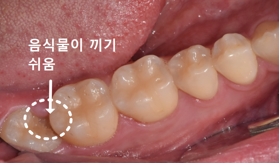 상일동 사랑니 매복 방치하다 옆 치아까지 망가진 실제 사례 관련 이미지 3