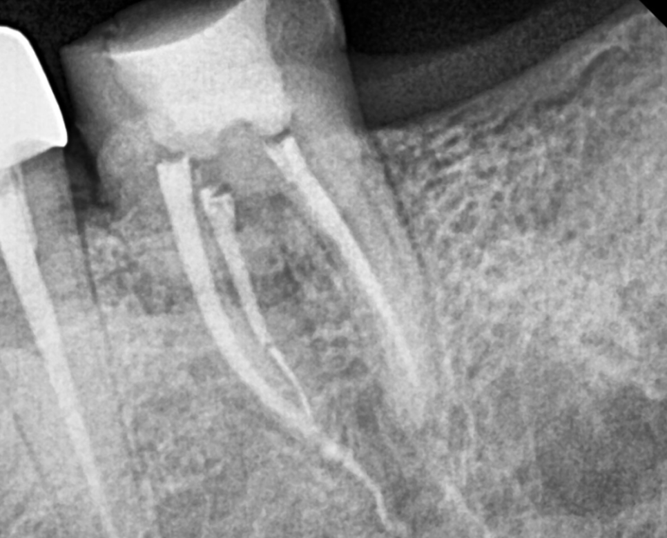 크라운 탈락 빠짐, 빠졌을 때 그대로 다시 붙일 수 있나요? 관련 이미지 4
