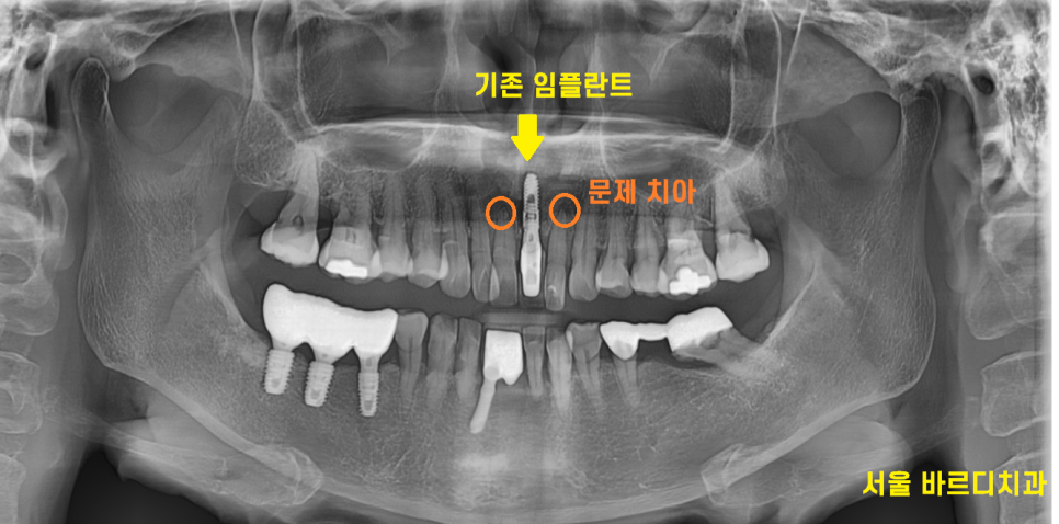미사 임플란트 보철 새로하고 연결했습니다. 관련 이미지 2