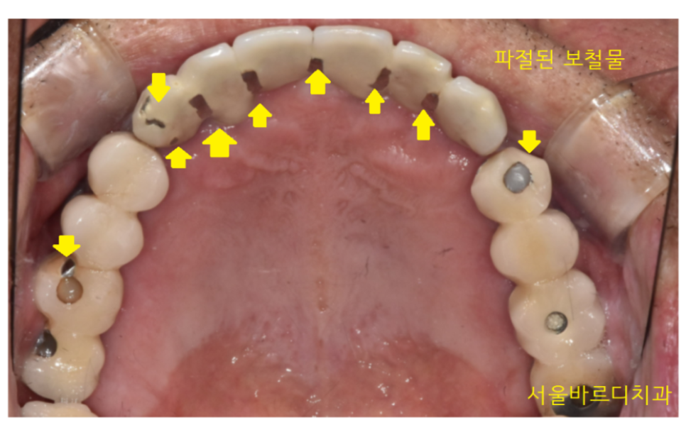 명일동 치과 임플란트 주의사항 끝날 때까지 끝난게 아니다 관련 이미지 6