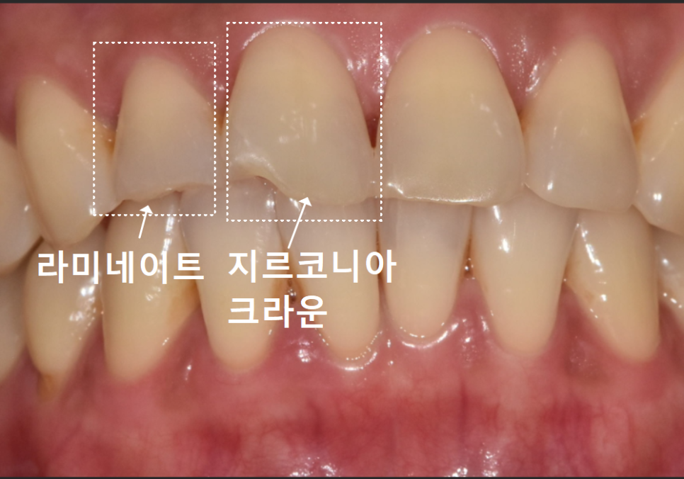 깨진 앞니 심미 치료, 라미네이트 vs 지르코니아 어떤 선택이 더 나을까? 관련 이미지 9