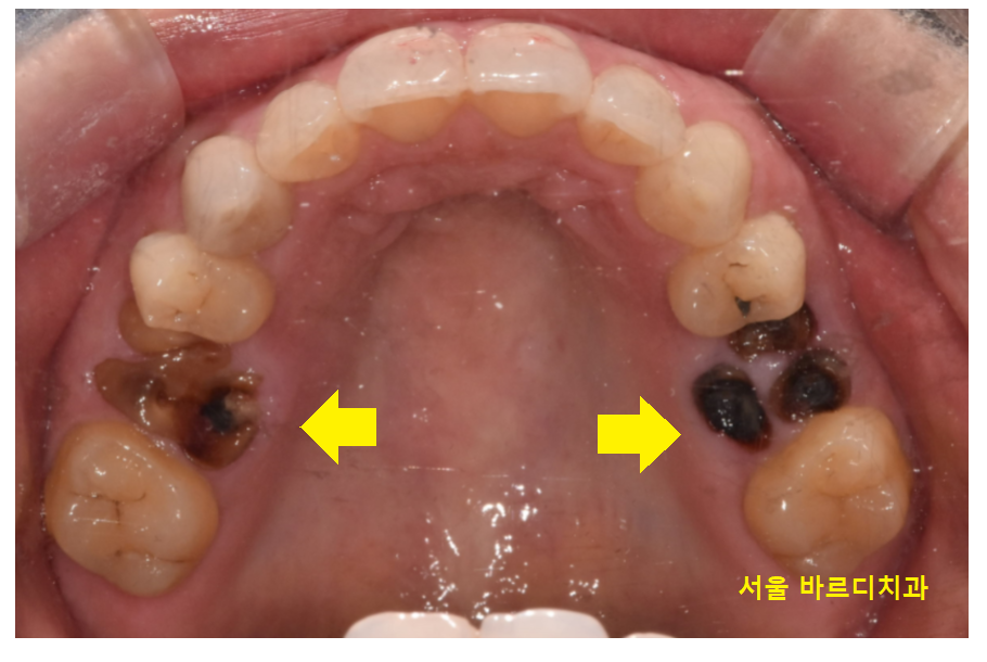 풍산동 치과 임플란트 양쪽 치료 가능한가요? 관련 이미지 3