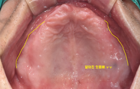 고덕역  치과 틀니쓰다 위아래 전악 임플란트 재건했습니다. 관련 이미지 4