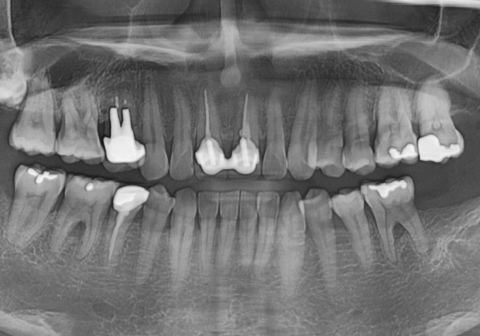 잇몸 까매짐 원인,증상,치료 방법 오래전에 앞니 씌운 곳 잇몸이 까매졌어요. 관련 이미지 6
