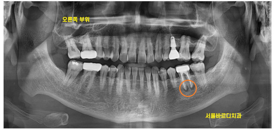 풍산동 치과 어금니 쪼개짐 임플란트를 해야할 때는? 관련 이미지 2