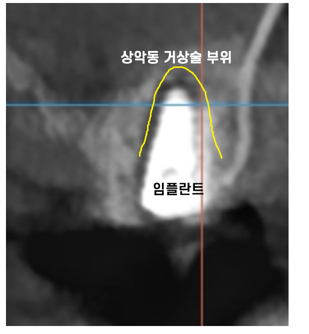 상일동 임플란트 상악동 거상술을 동반한 수술 증례 관련 이미지 8